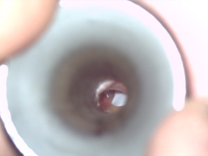 Fluid behind eardrum in an adult