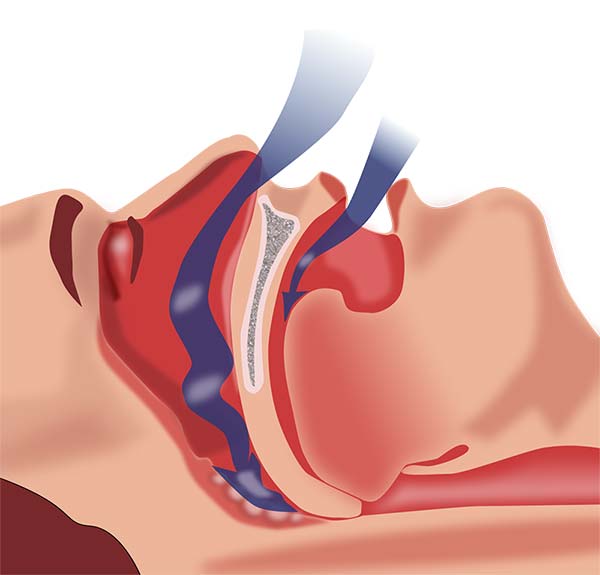 Sleep Apnea
